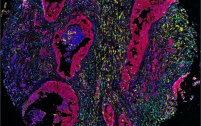microscopic breast cancer image