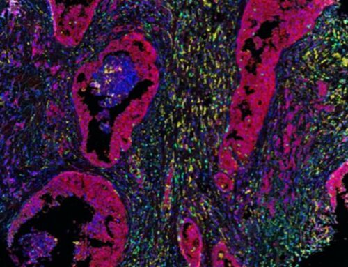 Understanding—and Interrupting—the Spread of Cancer